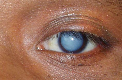 Most Common Eye Diseases