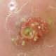 Staph Infection: Causes, Contagious, Symptoms, Treatment, and Pictures - HubPages