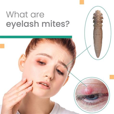What are eyelash mites? . There are two types of Demodex mites called Demodex folliculorum and ...
