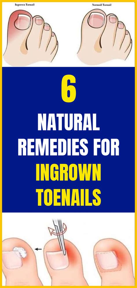 6 Natural Remedies For Ingrown Toenails
