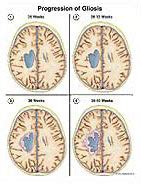 Medivisuals Progression of Gliosis Medical Illustration