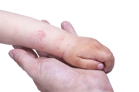 Dermatite atopica (eczema) - Amico Pediatra