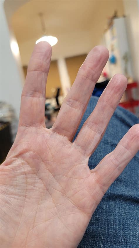 Anyone else have pruney fingers? : r/Sjogrens