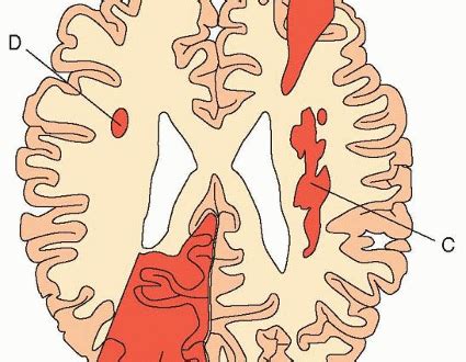 Hemiballismus Definition, Symptoms, Causes, Treatment