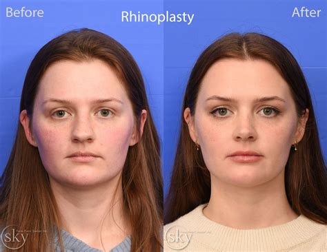 San Diego Rhinoplasty Specialist — SKY Facial Plastic Surgery