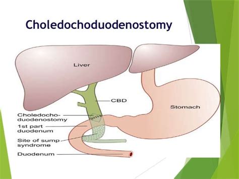 Choledocholithiasis...one step ahead