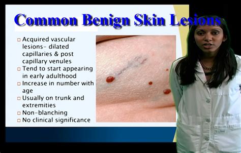 Dermatology: Common Benign Skin Lesions - Anatomy Guy