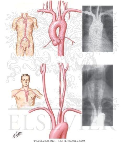 Thoracic Aortography