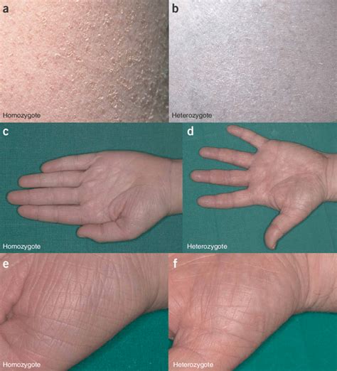 Clinical appearance of ichthyosis vulgaris. (a,c,e) Full presentation... | Download Scientific ...