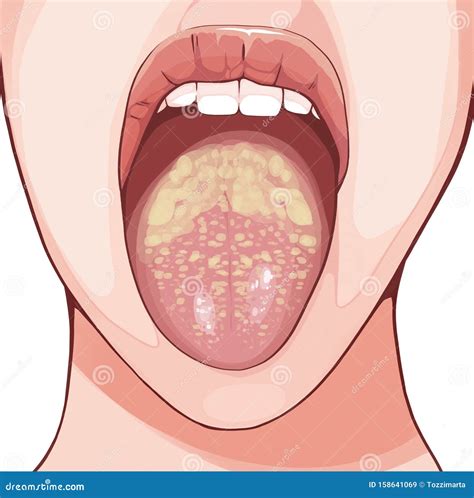 Fondos Pino Desgastado diseases caused by candida Estragos locutor alondra