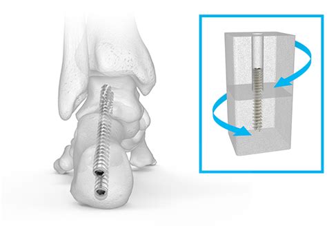 Triple Arthrodesis | Acutrak Advantage