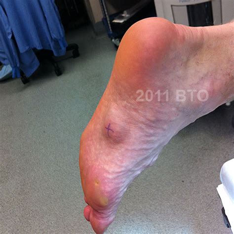 Plantar fibroma - Foot and AnklePlantar fibroma - Foot and Ankle | BoneTumor.org