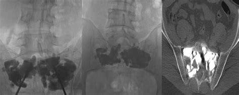 Treatment of sacral aneurysmal bone cyst with percutaneous sacroplasty - The Spine Journal