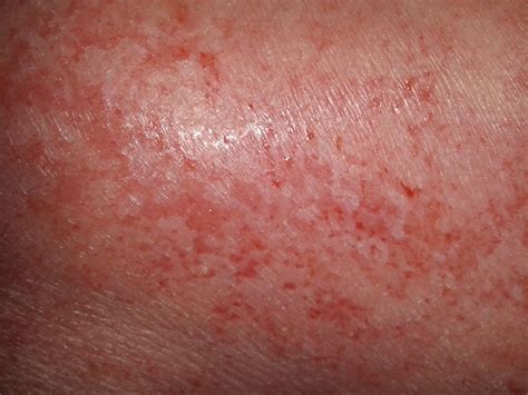 Sepsis Skin Rash Images