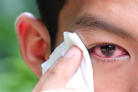 Know All About Conjuctivitis/Madras Eye, Causes, Symptoms