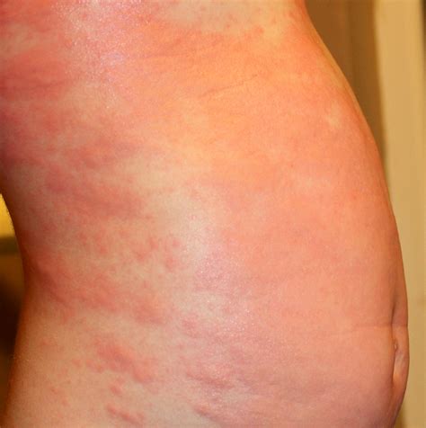 Urticaria Hives In Children Symptoms Rash Causes Trea - vrogue.co