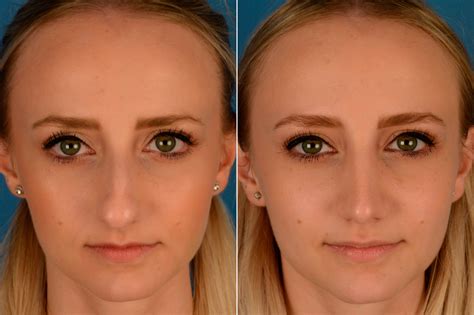 Rhinoplasty Photos | Naples, FL | Patient 13809