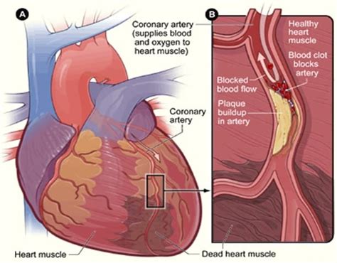 Pathophysiology Of Ischemic Heart Disease