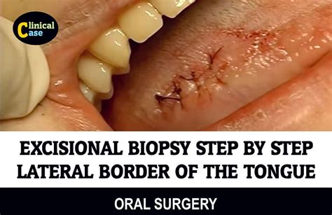 EXCISIONAL BIOPSY: Lateral border of the tongue Step by Step