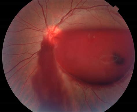 Vitreous Hemorrhage - Retina Eya Care, P.C.