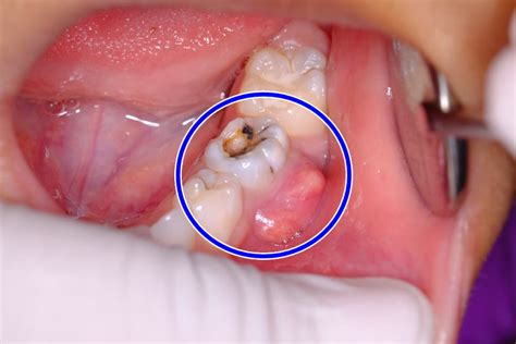 how to drain a tooth abscess - Crista Cowles