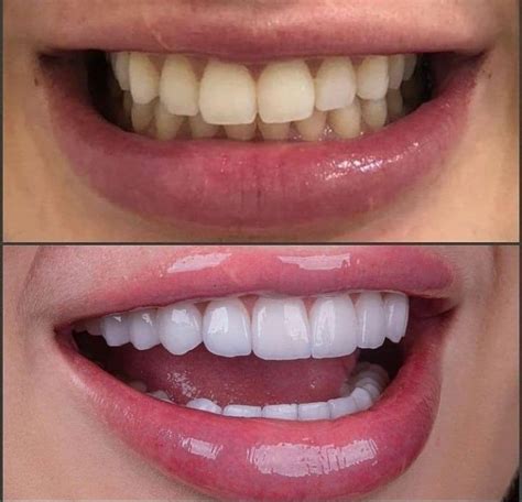 Pin on Dental Transformations - Bad Teeth To Good Teeth