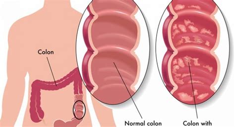 Can ulcerative colitis cause colon cancer? – Abdominal pain