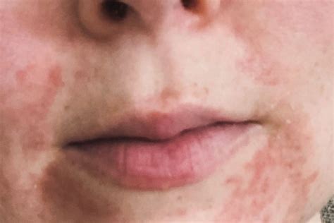 What is perioral dermatitis: All about its causes, treatments and healing stages