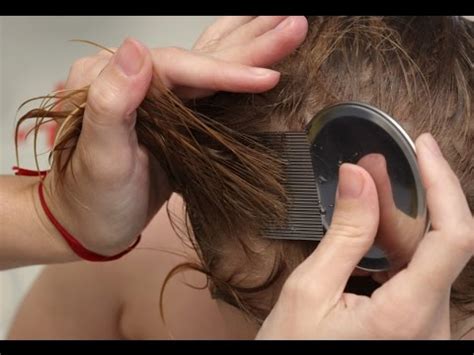 How to get rid of nits - YouTube