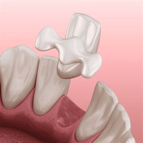 Resin Bonded Bridges- Virginia Bridges And Maryland Bridges - Anaya Dental