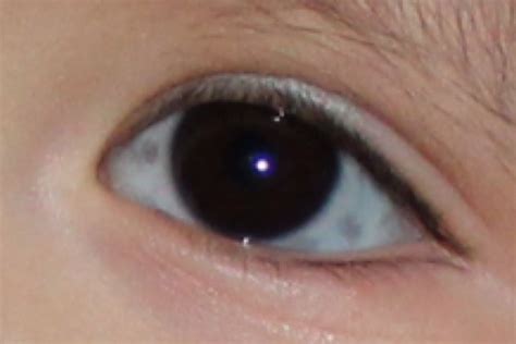 Grey spots on white of eye | original poster's comments | BabyCenter