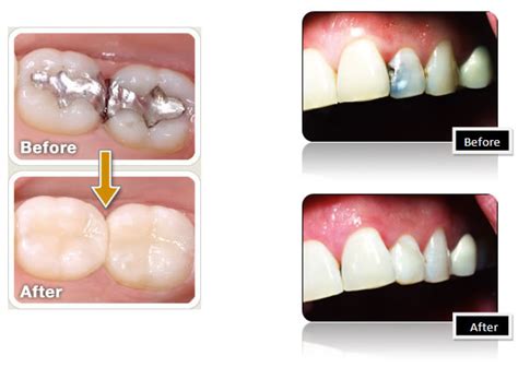 decaying teeth treatment