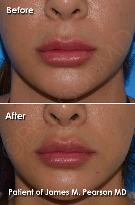 Lip Lift Photos - Before & After - Dr. James Pearson Facial Plastic Surgery