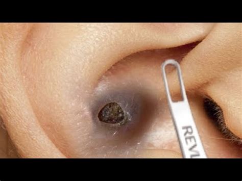 Relax Every Day Spa #0272 Popping huge blackheads and Pimple Popping ...