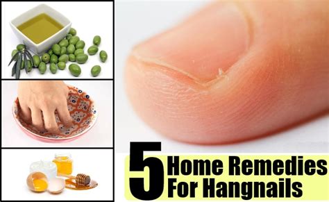 5 Home Remedies For Hangnails – Natural Home Remedies & Supplements