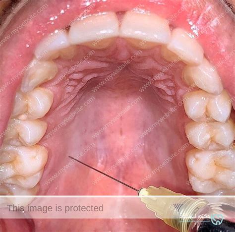 بيعمل extraction من غير ما يدي palatal infiltration - دكتور لود