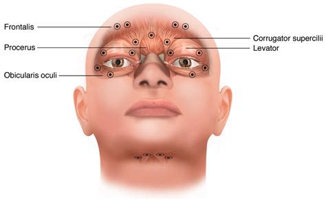 Blepharospasm Botox Before And After