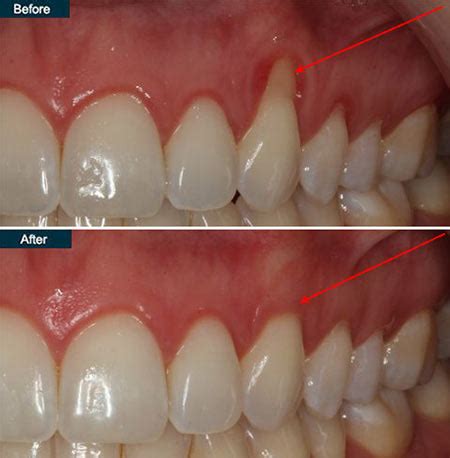 Gingivitis Before And After Treatment