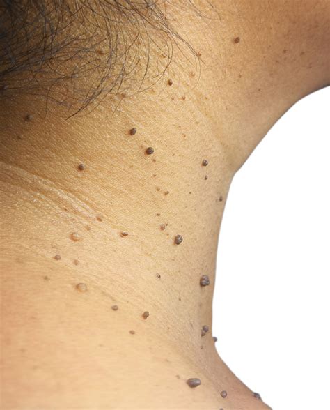 Skin Tag Removal NW DC | GZ Skin and Face