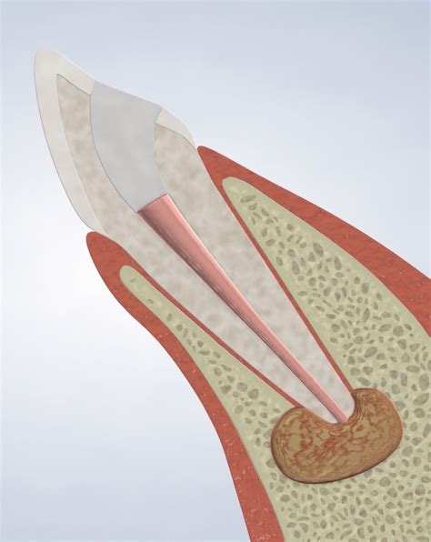 Apicoectomy in Lebanon, PA | Treatment for Failed Root Canal