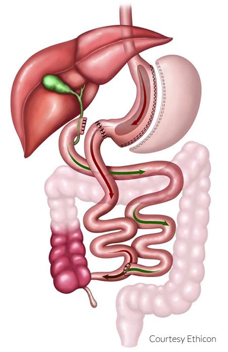 Duodenal Switch (DS) Surgery in Mobile, AL