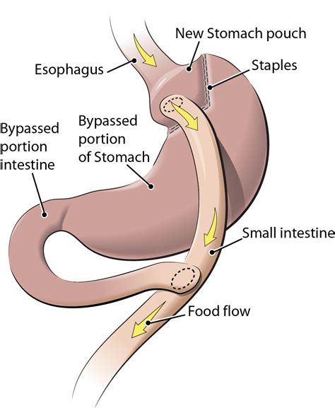 Requirements How to Get Gastric Bypass Surgery