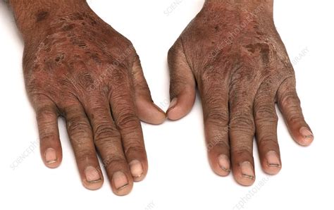 Pellagra due to niacin deficiency - Stock Image - C052/5765 - Science Photo Library