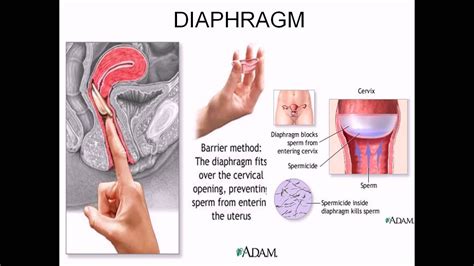 Diaphragm contraceptive - YouTube