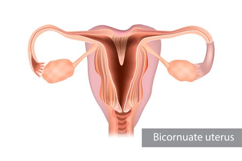 Bicornuate Uterus - Causes, Symptoms & Treatment - Being The Parent