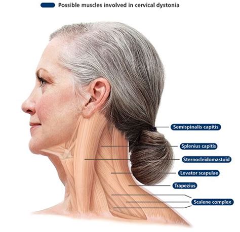 Cervical Dystonia Pain