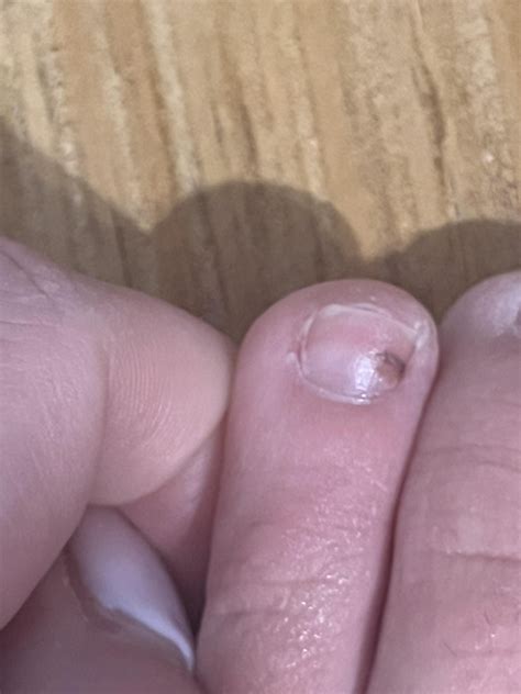 Toenail melanoma or hematoma? : r/Melanoma