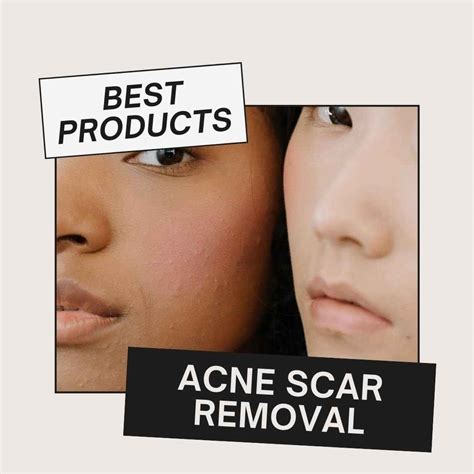 Best Products For Acne Scars UK 2023 | Products For Spotless Skin I tried - Discount Age