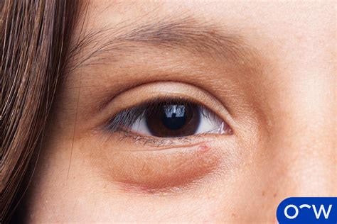 Puffy Eyes: Definition, Causes, Symptoms, and Treatment