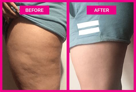 Cellulite Cupping Before And After Photos That Will Make, 42% OFF